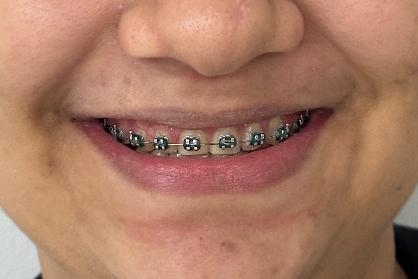 Rosto de homem de boca aberta mostrando os dentes
Descrição gerada automaticamente