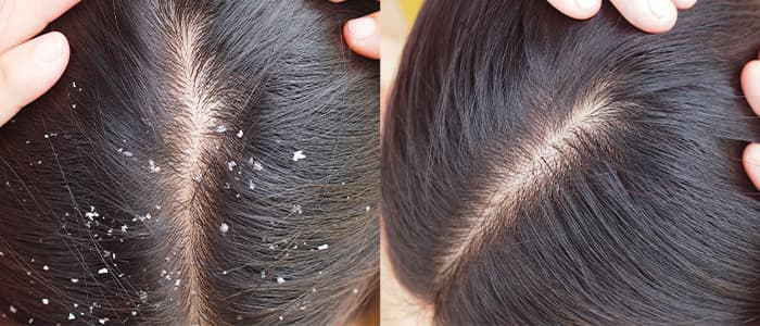 in this image we can see the before and after dandruff treatment results. by https://renewyou.co.in/