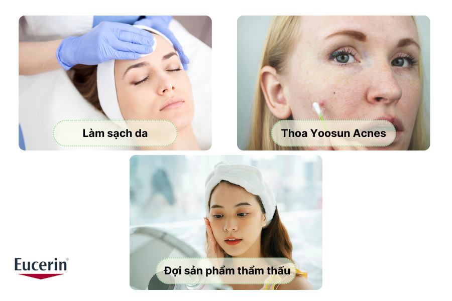 Cách sử dụng Yoossn Acnes