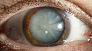 Cataract eye problem