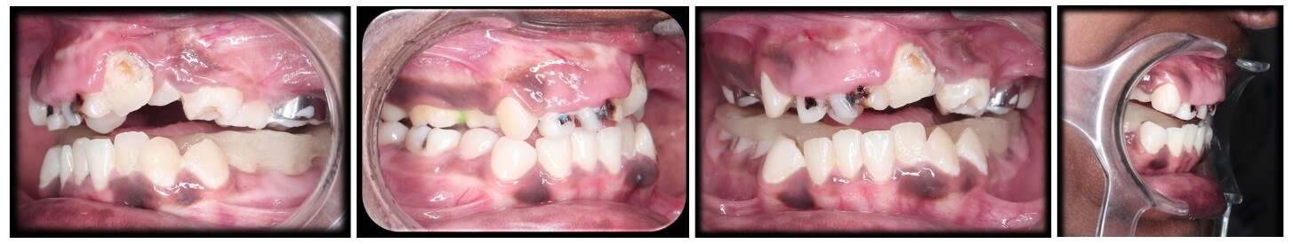 posterior bite plane