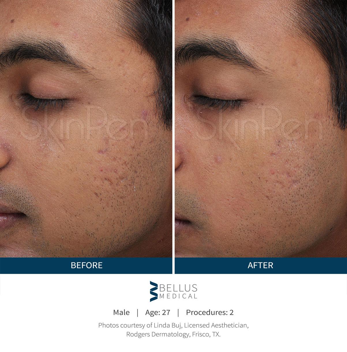 https://bellusmedical.com/wp-content/uploads/2018/06/skinpen-male-before-after-1.jpg