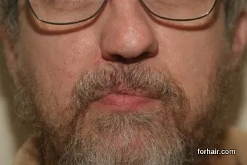 Forhair's patient with cleft lip scar - results