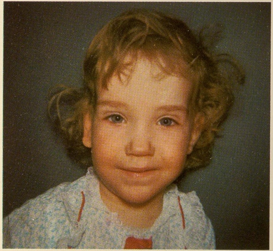 Child with facial features of syndrome