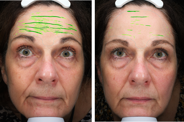 A person with wrinkles on her forehead  Description automatically generated