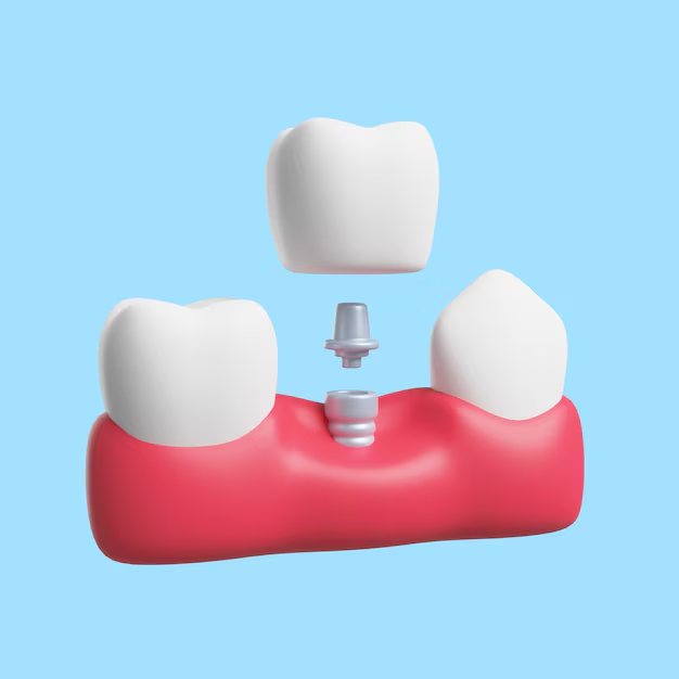 one tooth bridge