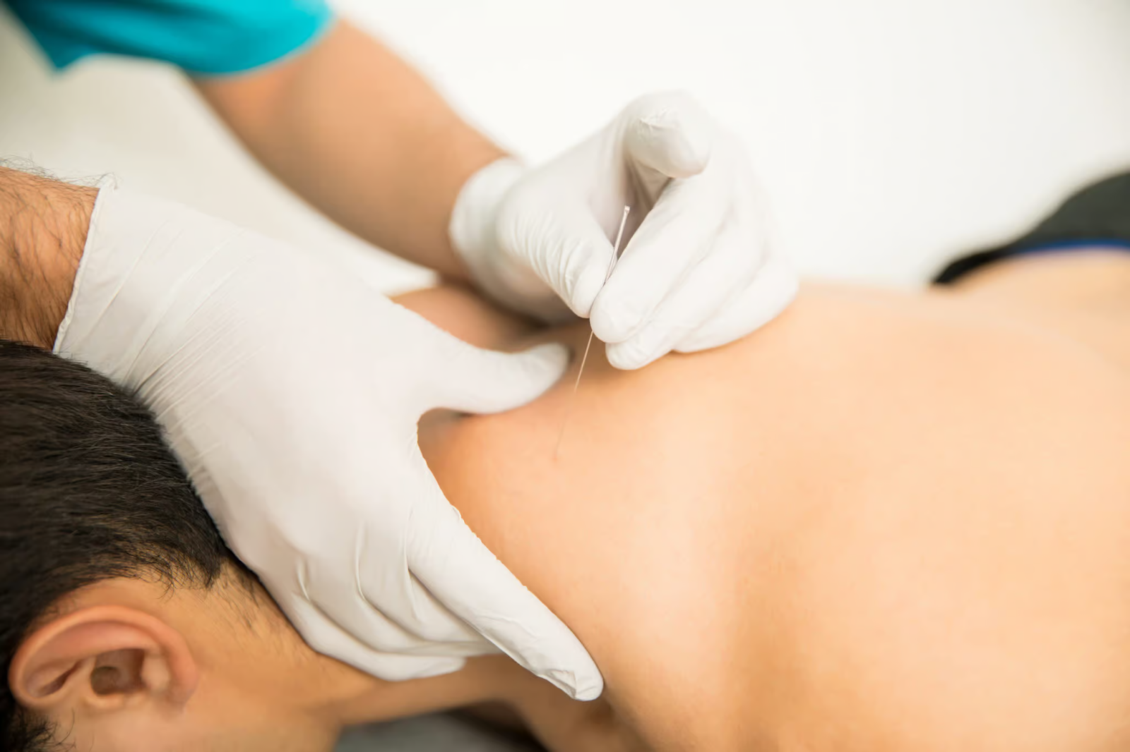 Exploring Back Pain Relief with Acupuncture Encinitas