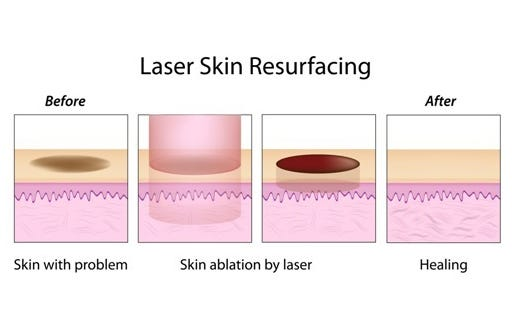 in this image the laser skin resurfacing process is defined