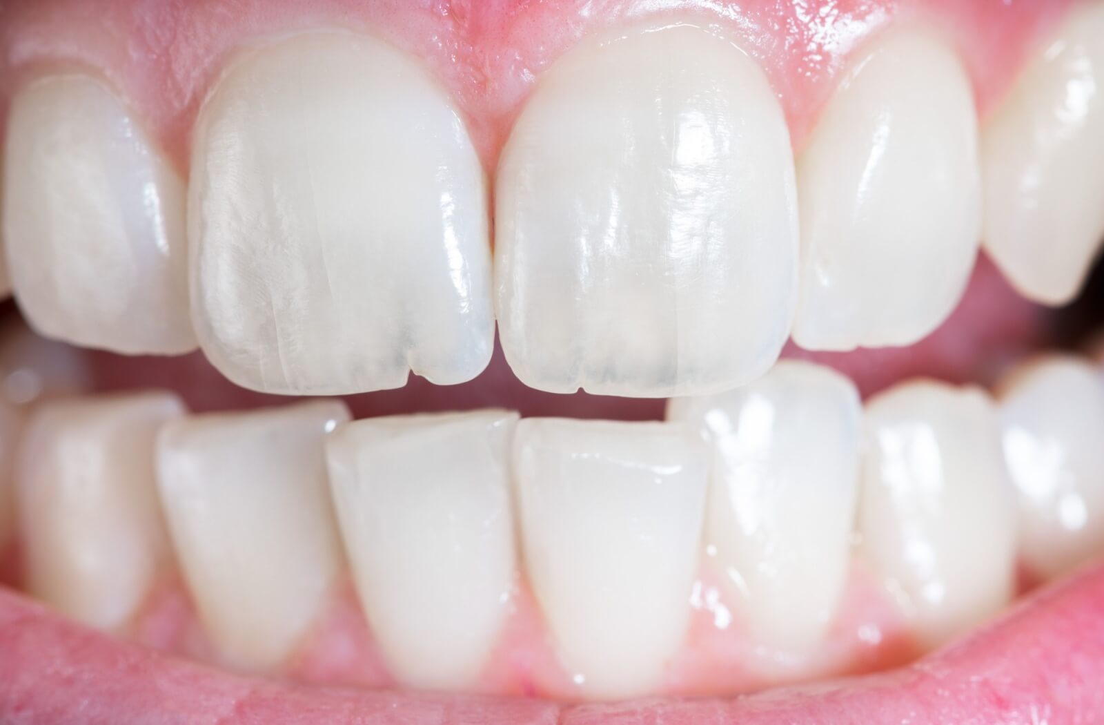 A close-up image of white teeth with multiple micro-fractures and chips in them.