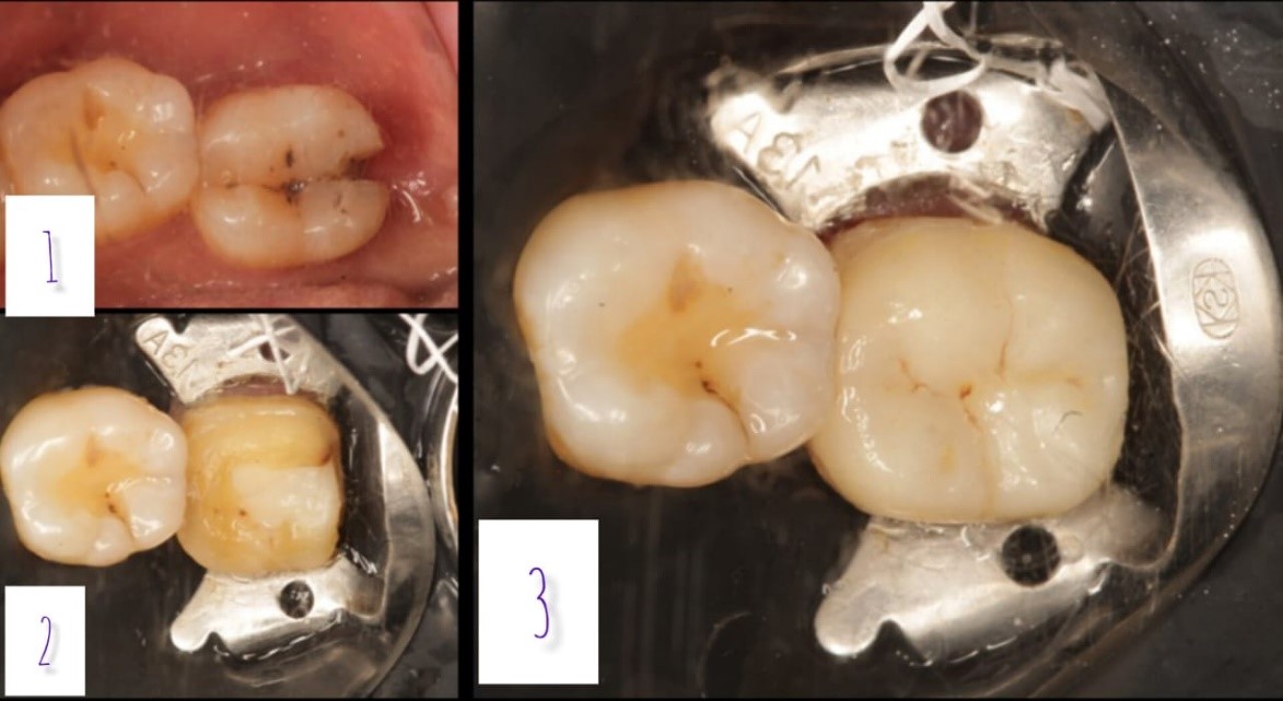 Root Canal Treatment 