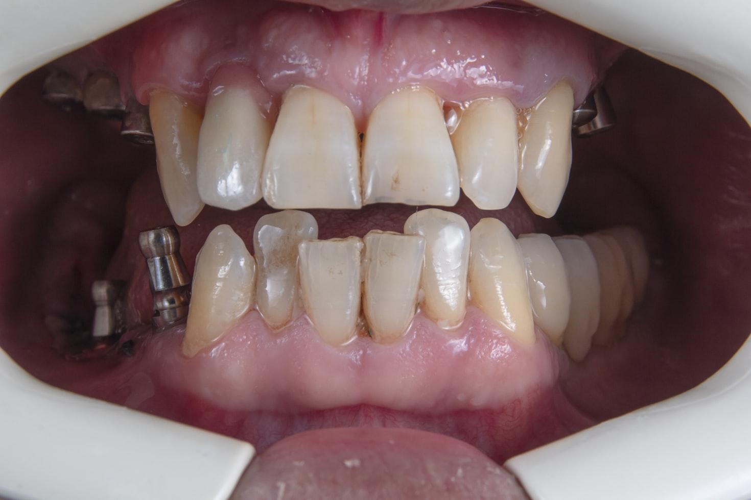 affordable dental implant