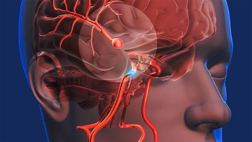 Atenção e cuidados nos quadros de aneurisma cerebral