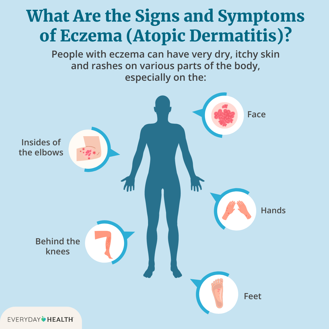 Common Symptoms of Eczema