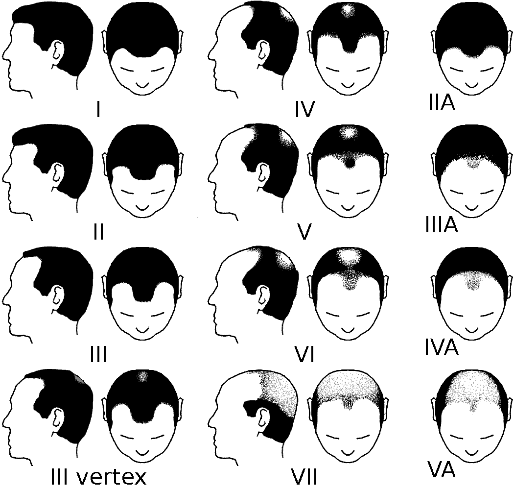 Norwood scale stages of male pattern baldness