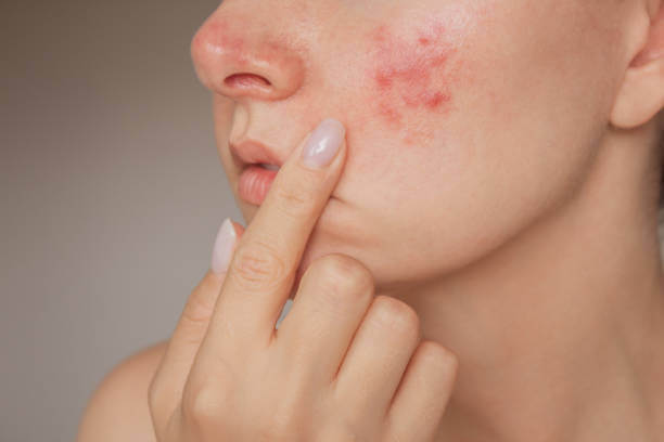 A close-up of a woman with rosacea, showing redness and irritation on her cheeks and nose.