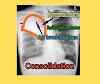 What is consolidation?