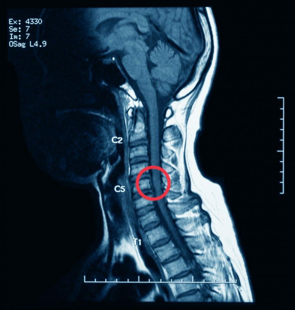 A close-up of an x-ray of a spine

Description automatically generated