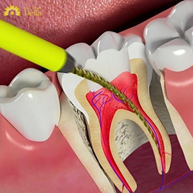 Giá cả của bọc sứ sẽ phụ thuộc vào địa chỉ nha khoa, loại sứ mà khách hàng chọn lựa