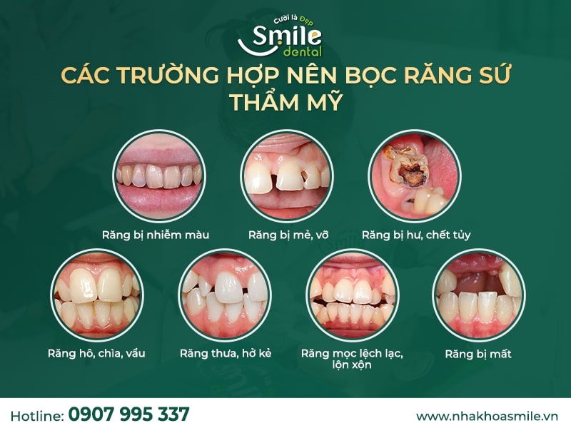 Các trường hợp nên bọc răng sứ thẩm mỹ