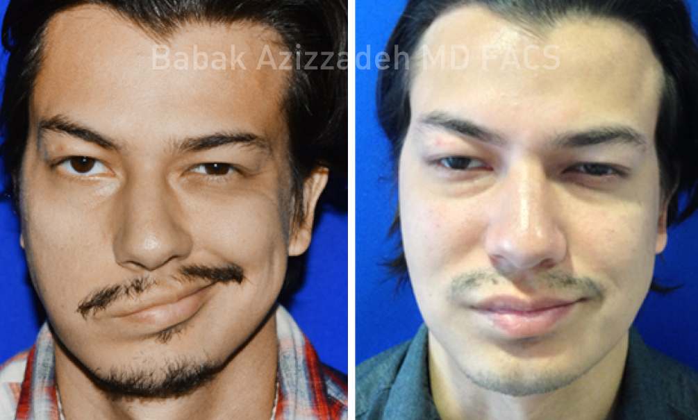 Masseter to Trigeminal Facial Nerve Transfer