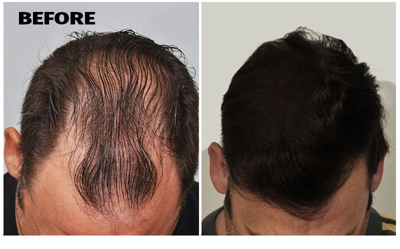 Before and after Hair Transplant 3394 grafts FUE
