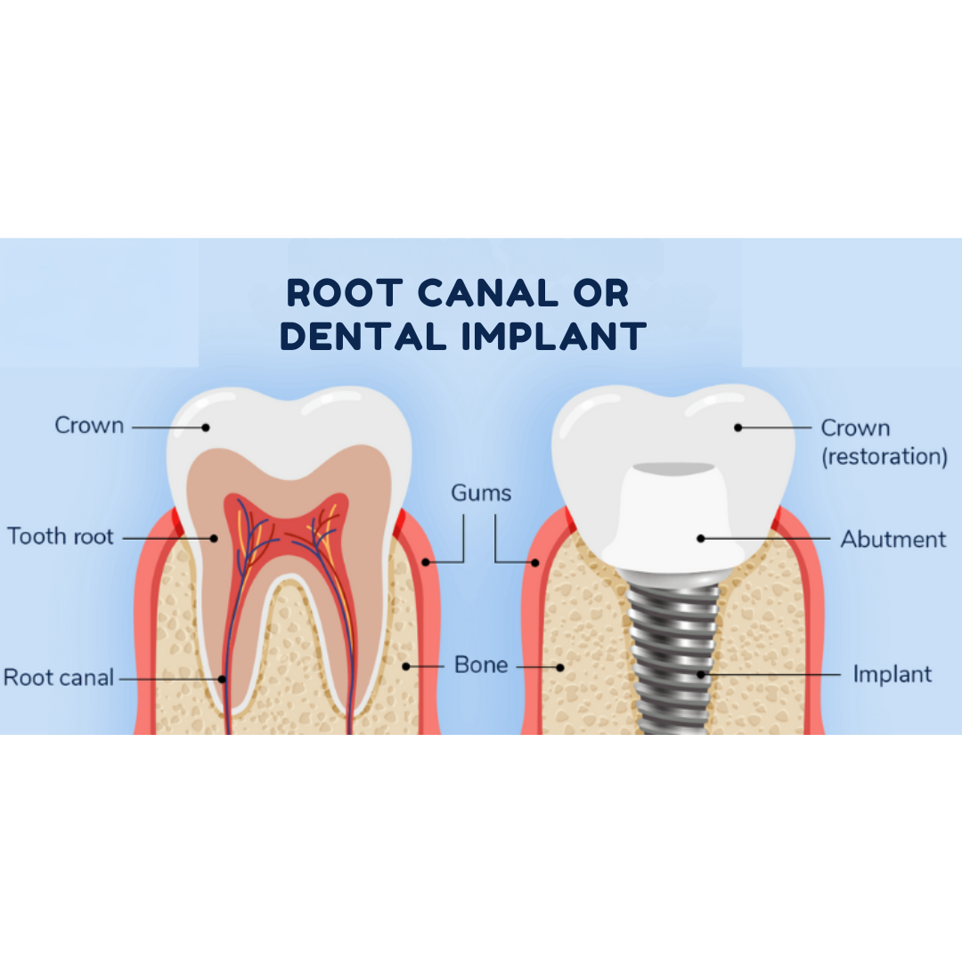 Root Canal or Implant – Which One Lasts Longer?