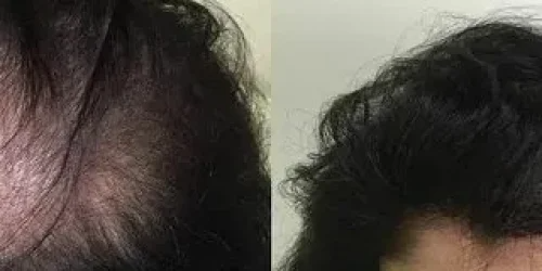 Restore Your Hair with Hair Restoration