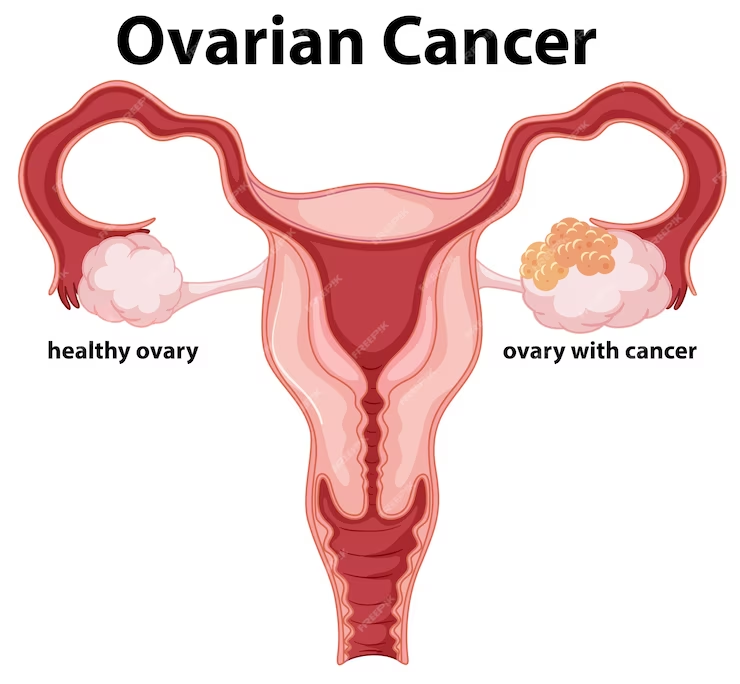 Ascites in Ovarian Cancer: Unraveling the Connection | ClinicSpots