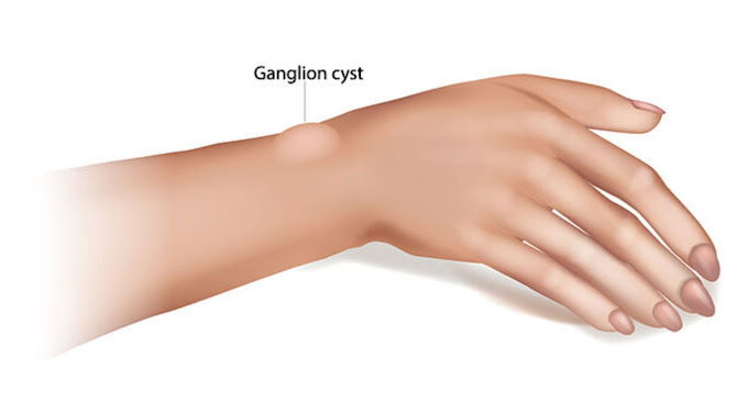 Ganglion Cyst Vitamin Deficiency