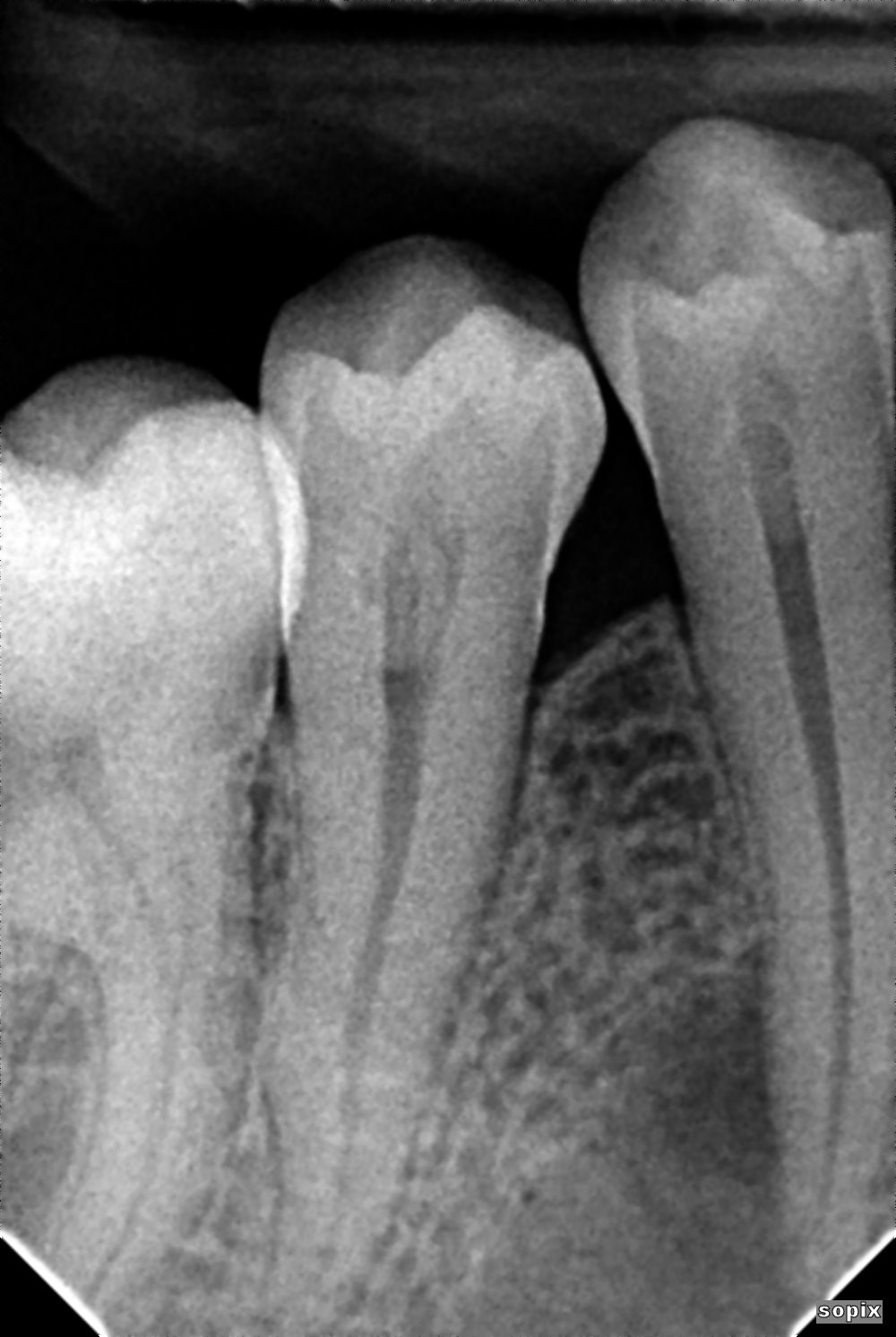 A close-up of a tooth x-ray
Description automatically generated