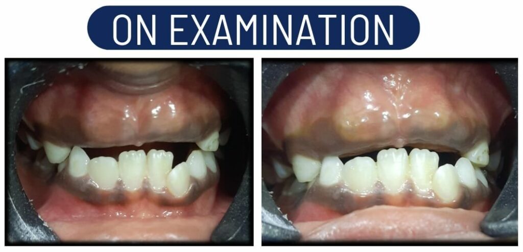 delayed eruption examination