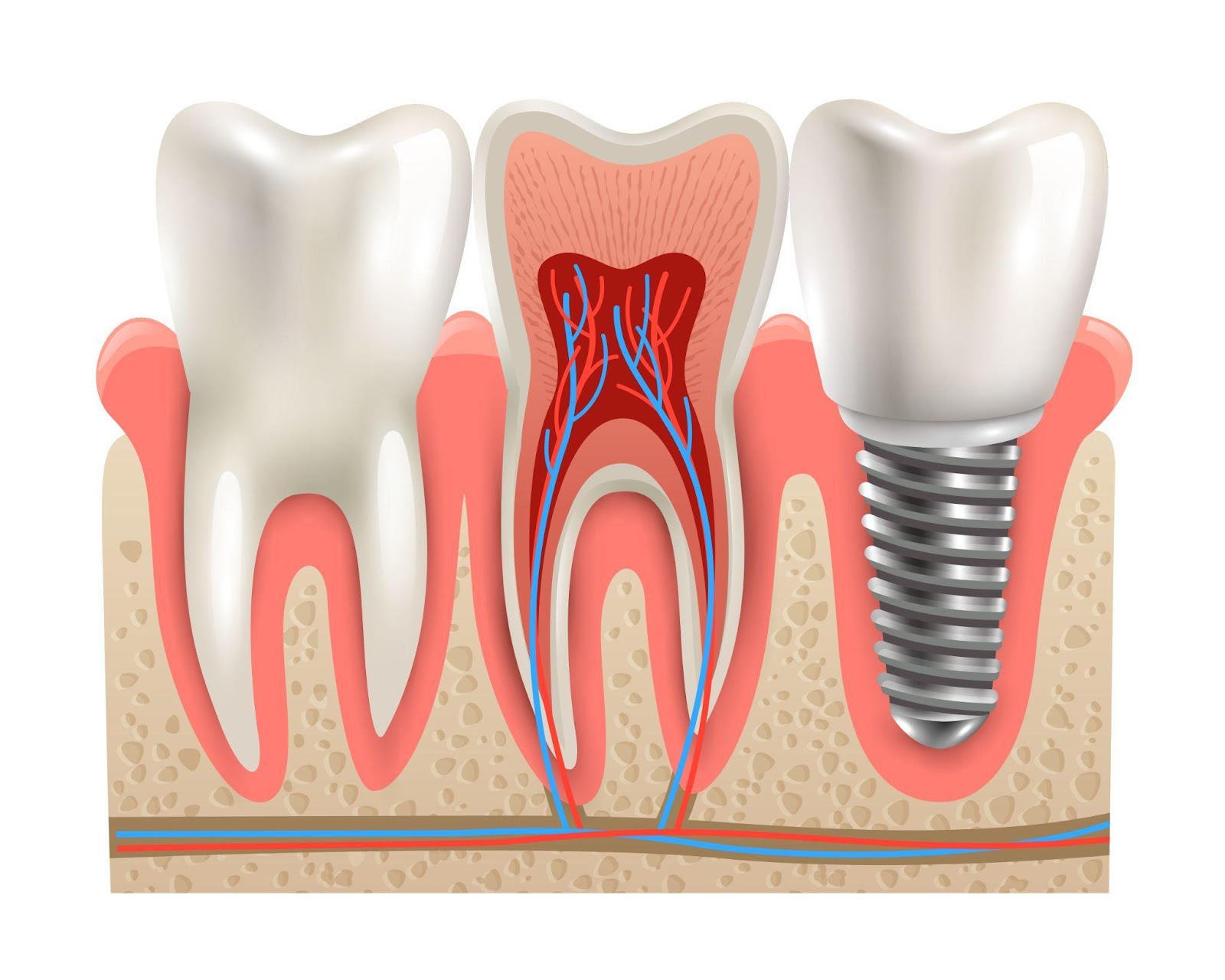 Tooth Implant