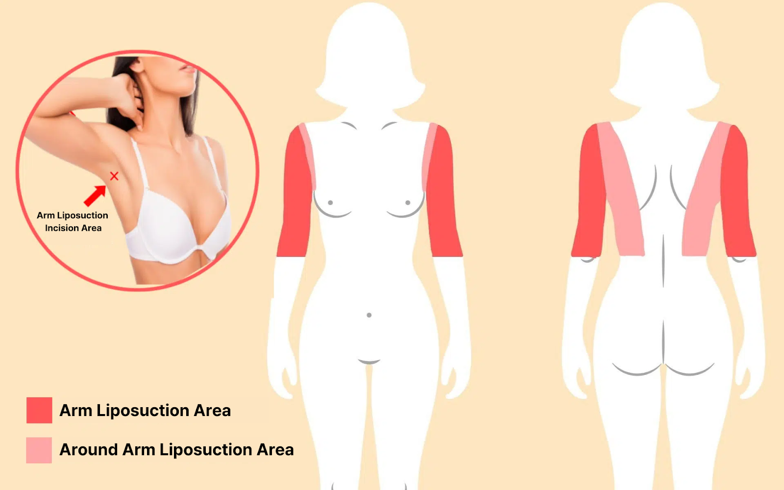 is arm liposuction worth it