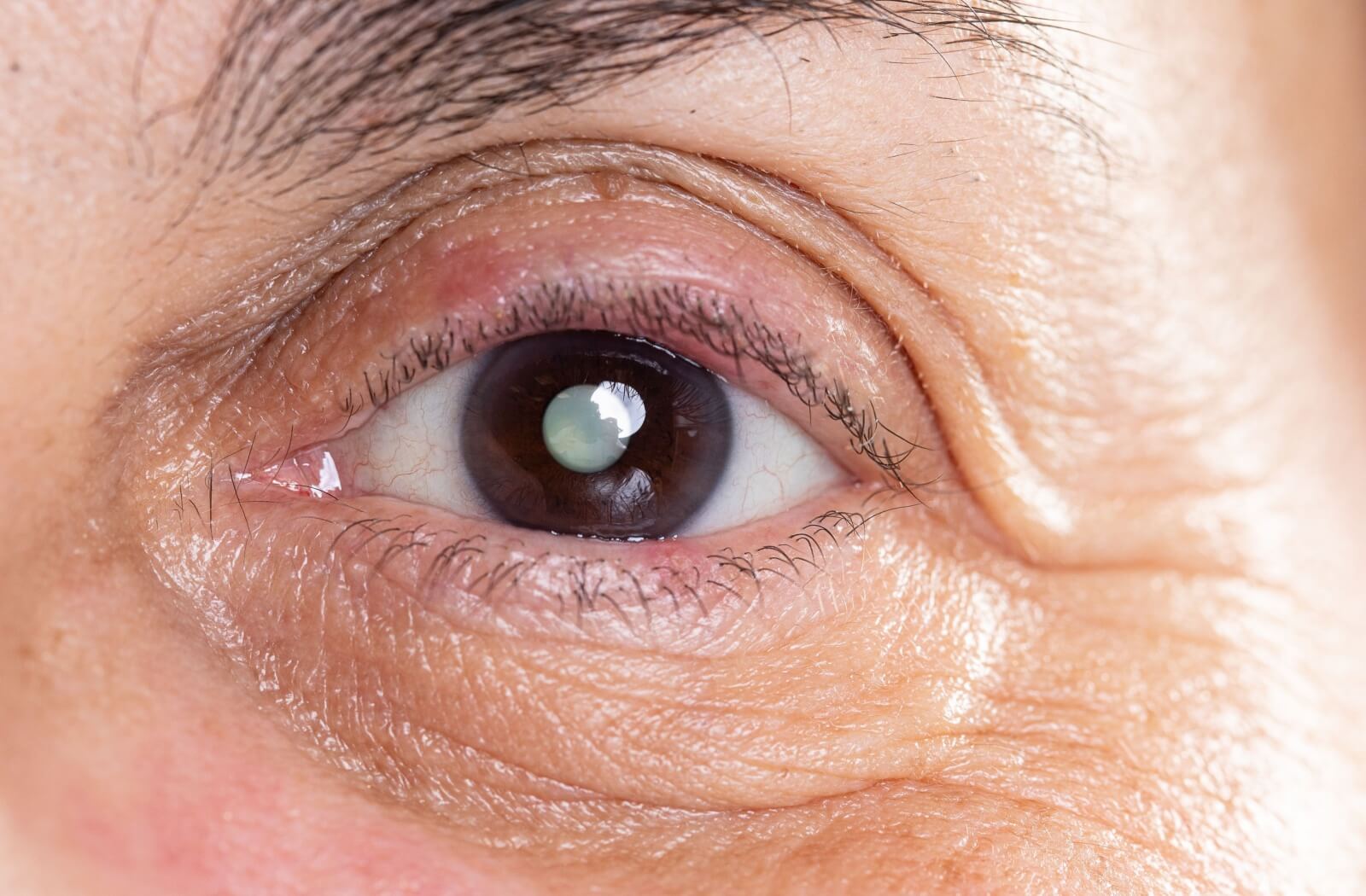 A close-up image of a cataract, demonstrating a risk of untreated myopia.