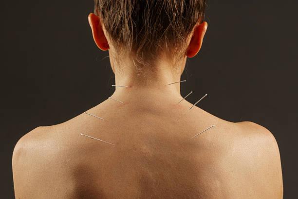 Acupuncture, needles and treatment of body in healthcare, healing muscle and back pain relief. Patient, anatomy and dry needling physiotherapy to relax person at salon and holistic care for injury. Acupuncture, needles and treatment of body in healthcare, healing muscle and back pain relief. Patient, anatomy and dry needling physiotherapy to relax person at salon and holistic care for injury. picture of dry needling stock pictures, royalty-free photos & images
