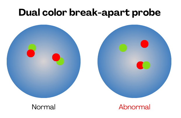 Illustration of FISH dual color break-apart probe. 