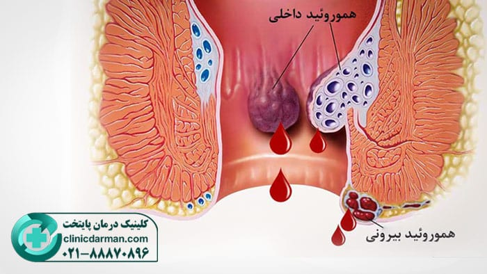 بواسیر داخلی و خارجی