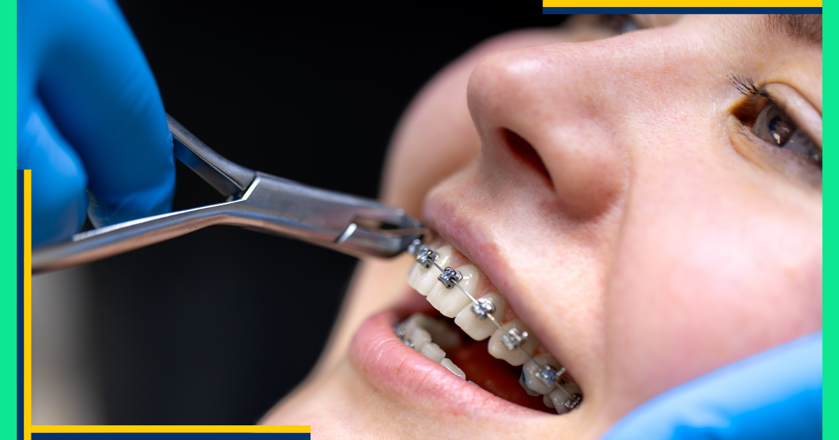 Za djecu, tinejdžere i odrasle, Dental Clinic nudi fiksne aparatiće ili providne alignere. Njihova individualizirana metoda čini ispravljanje zuba jednostavnijim nego ikad prije.