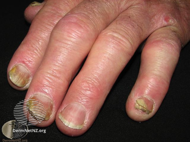 Fingernails with yellow-brown discoloration, thickening, onycholysis, and pitting, along with swollen finger joints, consistent with psoriatic nail changes.
