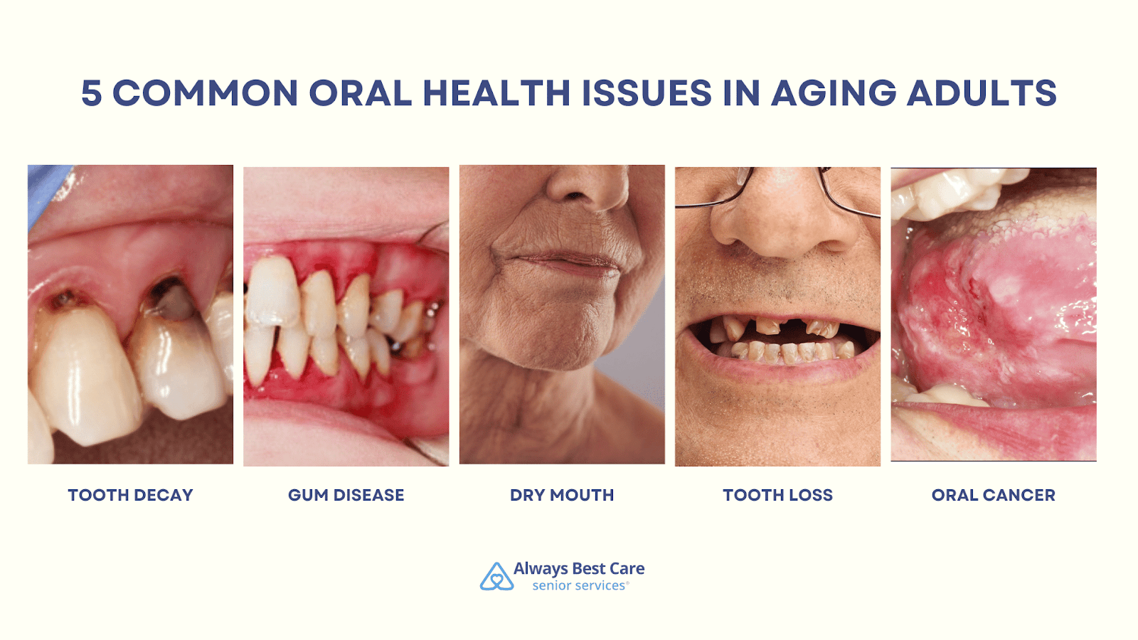 This is an infographic depicting the 5 common oral health issues in seniors