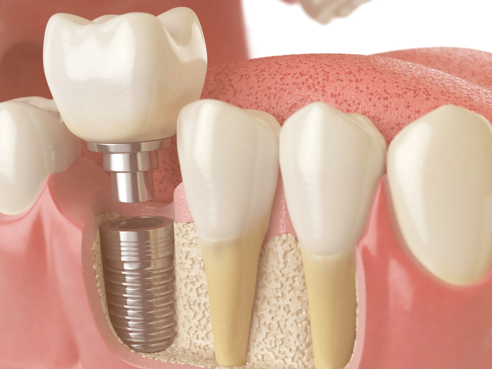 Cấy ghép Implant Hàn Quốc hiện nay được đánh giá cao vì có giá thành hợp lý và độ ổn định cao