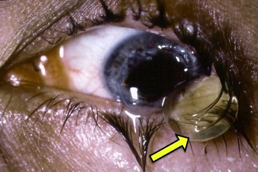 Close-up of a human eye with a bug in it

Description automatically generated