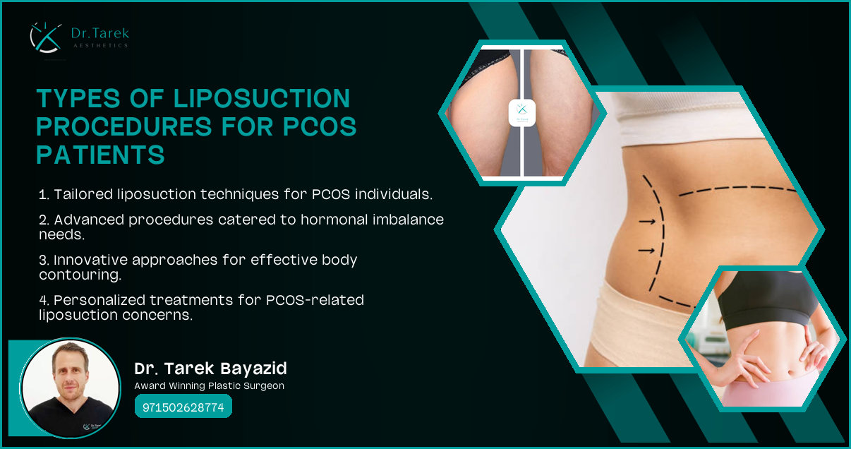 Can Liposuction Help Pcos