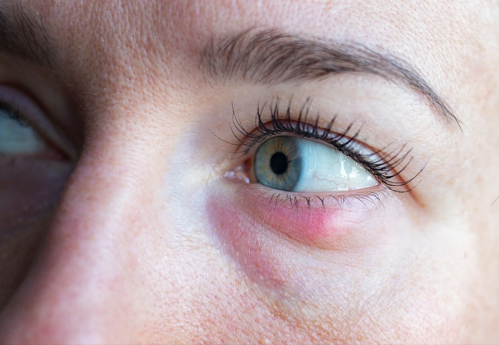 A close-up image of a person's left eye with a stye on the lower eyelid.