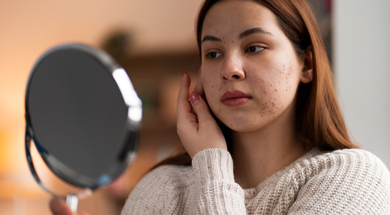 Acne Scar Treatment