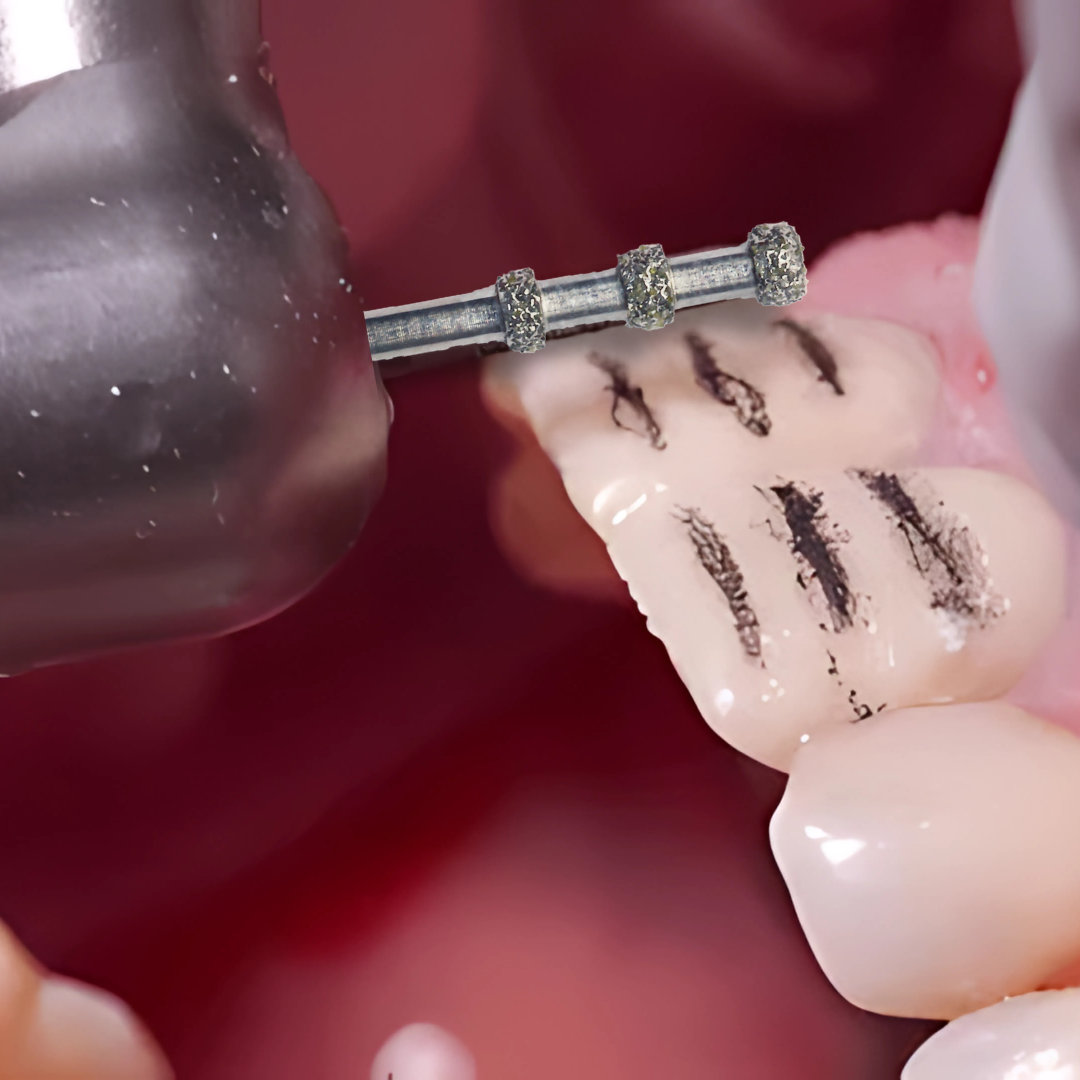 Mr. Bur Depth Marker Bur used for aesthetic excellence with ultra-thin porcelain veneers, ensuring precise enamel reduction and natural-looking restorative outcomes.