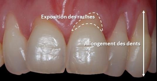 C:\Usuarios\DELL\Imágenes\DR-RONCO-PERIODONTOLOGÍA-ESPECIALISTA-INJERTO-ENCÍA-MICROCIRUGÍA GINGIVAL-MINIINVASIVA-PLÁSTICA-CONSECUENCIAS-RECESIÓN-RETRACCIÓN-ENGIVAL-ENCÍA.jpg