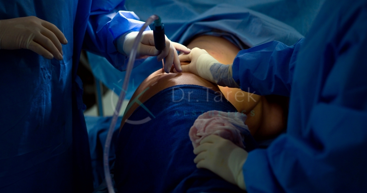 Can A General Surgeon Do Liposuction