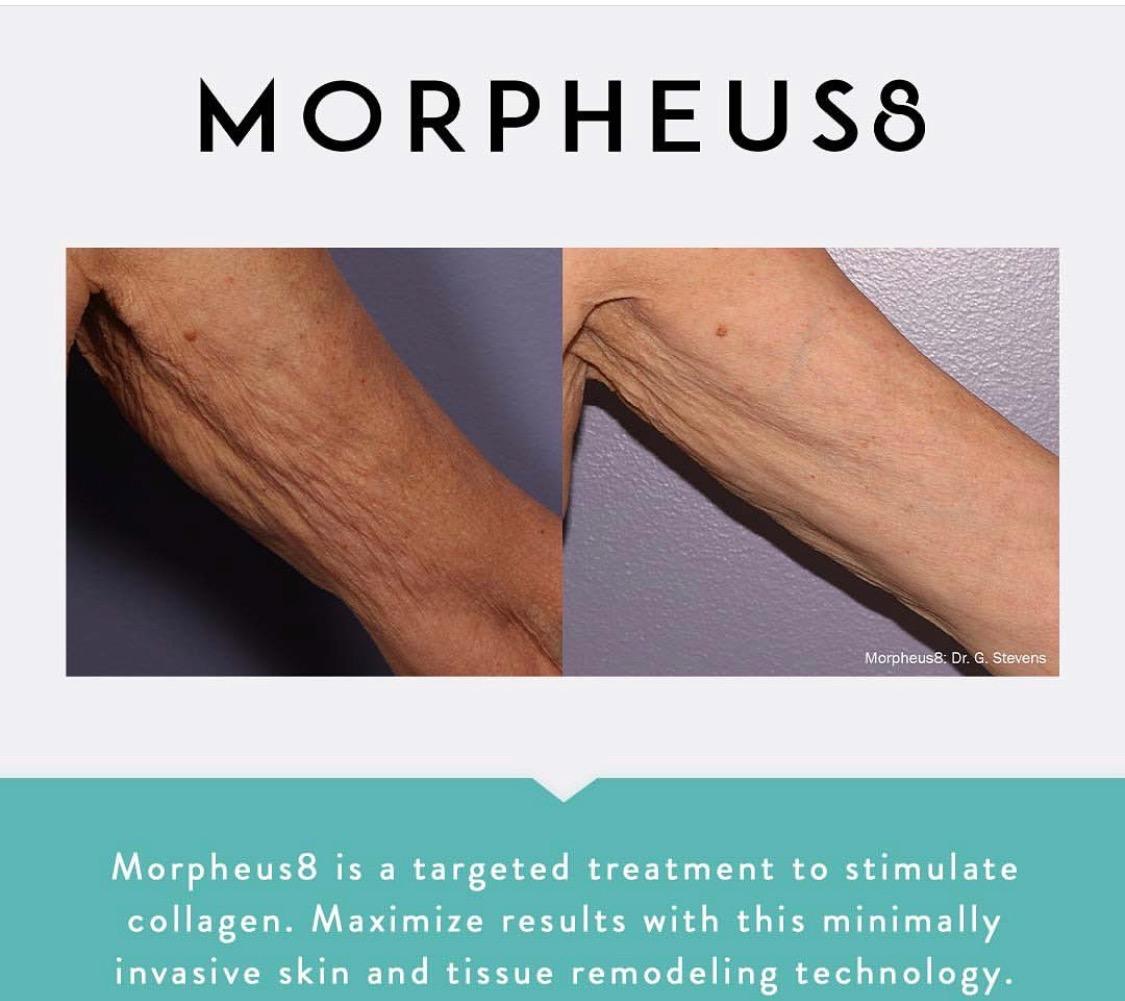 MORPHEUS 8 | Opulence Glamour Skin Clinic | New York | Biologique Recherche  | Morpheus 8 | Icoone Med Laser | Morpheus 8