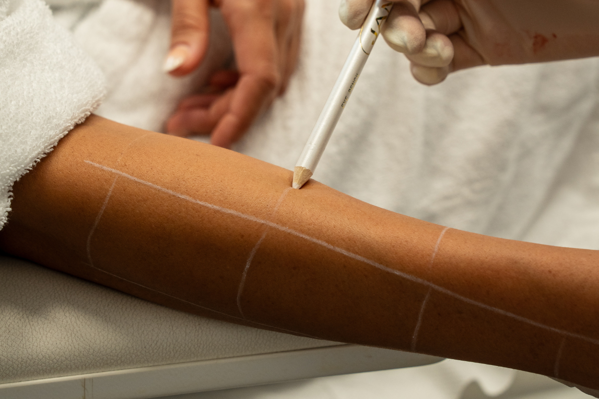 Preparation for laser hair removal treatment